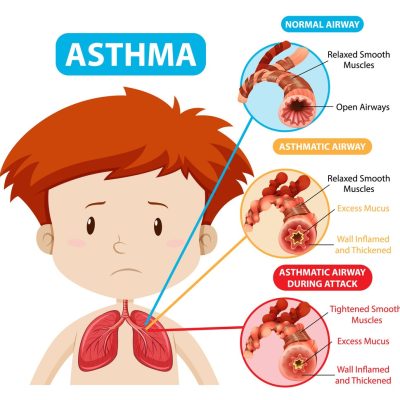 Asthma diagram with normal airway and asthmatic airway illustration